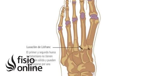 Articulación de Lisfranc Qué es partes tipo de articulación y