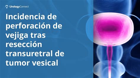 Resección transuretral de tumor vesical riesgos de perforación de