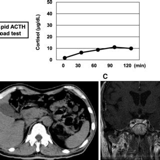 (PDF) Idiopathic and isolated adrenocorticotropic hormone deficiency presenting as continuous ...