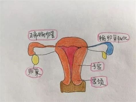 输卵管积水按积水程度可分为三度 凤凰网