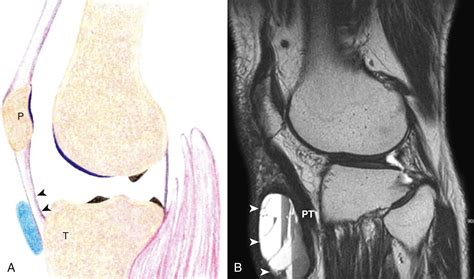 Superficial Infrapatellar Bursa Injection Clinical Tree