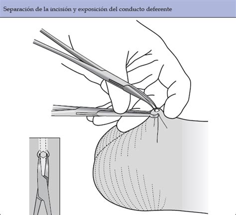 Procedimiento Vasectomía