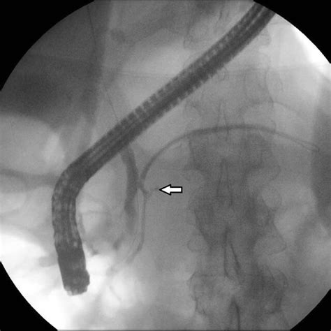 Ercp Fluoroscopic Image Demonstrating Cannulation Of The Pancreatic Download Scientific Diagram