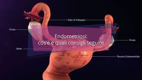 Endometriosi Cos E Quali Consigli Seguire News Salute La Vita