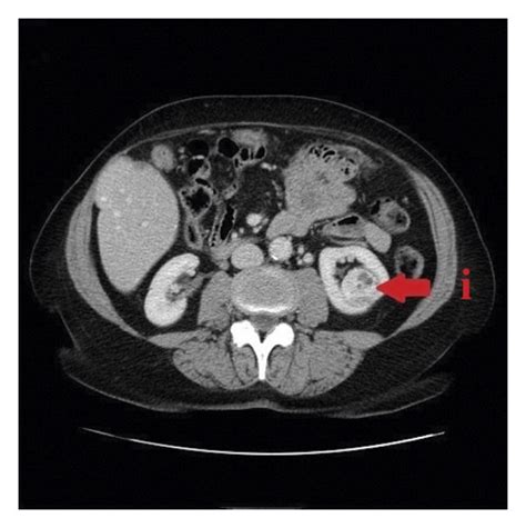 A Preoperative Ct Imaging Of I Endophytic Renal Tumor Before Download Scientific Diagram