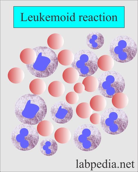 Leukemoid Reaction And Diagnosis D D From Chronic Myelocytic Leukemia