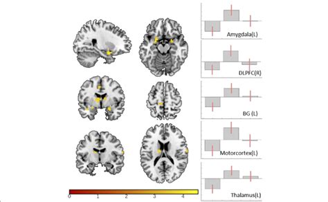 Polarity Dependent Effect Of TDCS On Trigeminal Nociceptive Processing