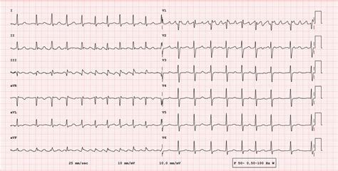 Higher Right Ventricular Afterload In Older Adults Linked To Greater