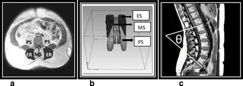 Axial Cross Sectional Image Illustrating Erector Spinae Er