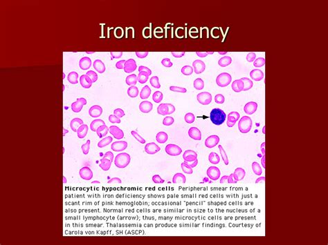 Antibiotics And Iron Deficiency Anemia