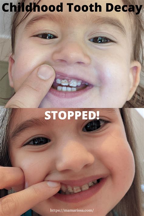 Tooth Decay In Children 3 Simple Natural Treatments • Mama Rissa