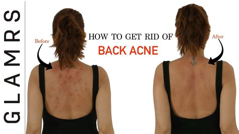 How To Get Rid Of Back Acne The Natural Way Effective Home Remedies