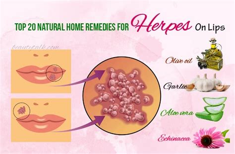 Top 20 Natural Home Remedies For Herpes On Lips