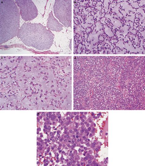 Histologic Examples Of Extraskeletal Myxoid Chondrosarcoma A Classic