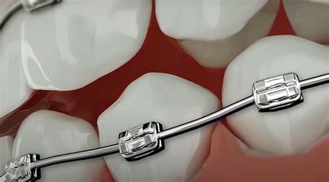 Broken Brackets - What You Need to Know - Premier Orthodontics