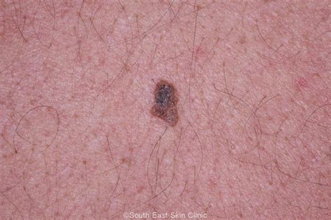 Seborrhoeic Keratosis - How to idenitify Seb K - Extensive Gallery.