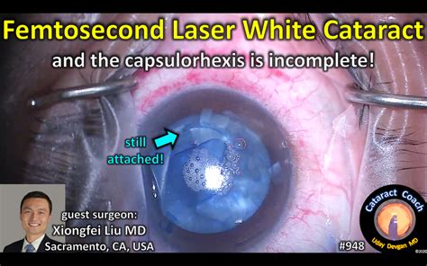 Femtosecond Laser White Cataract Cataract Coach™