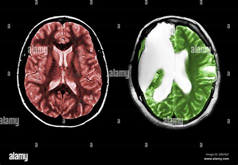 MRI of Normal Brain and Hemispherectomy Stock Photo - Alamy