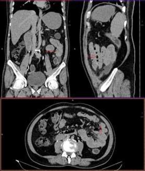 Perforated Jejunal Diverticulum With Collection And Air Noted Within