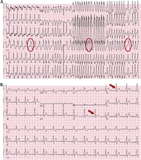 Atrial Fibrillation In Wolff Parkinson White Syndrome JACC Case Reports