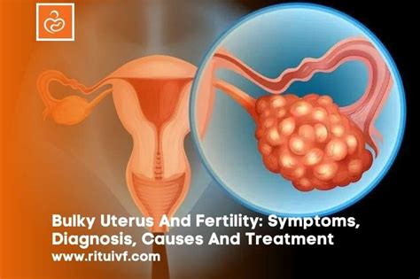 Bulky Uterus And Fertility Symptoms Diagnosis Causes Treatment