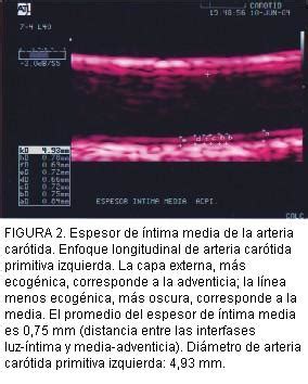 Disfunci N Endotelial Espesor De Ntima Media Y Placas De Ateroma