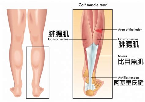 【x3按摩槍教室 X 筆記治療師】小腿肌肉好痠痛 用槍方式勿踩雷 文章 運動筆記