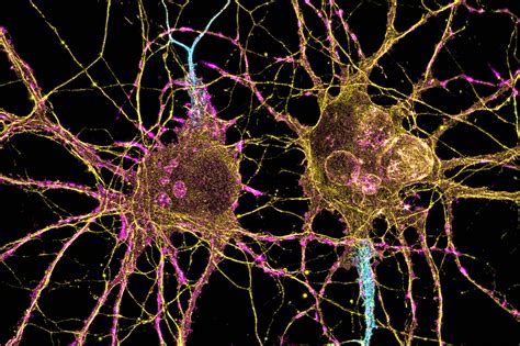 How Huntingtons Disease Affects Different Neurons Mit News