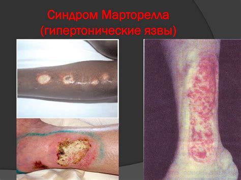 Хроническая венозная недостаточность нижних конечностей - презентация ...