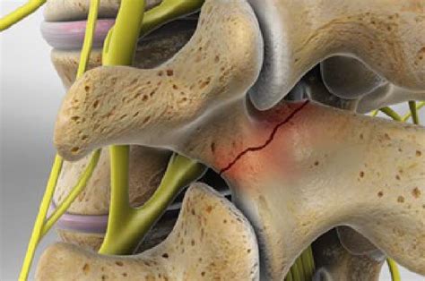 Spondylolysis Stl Misc