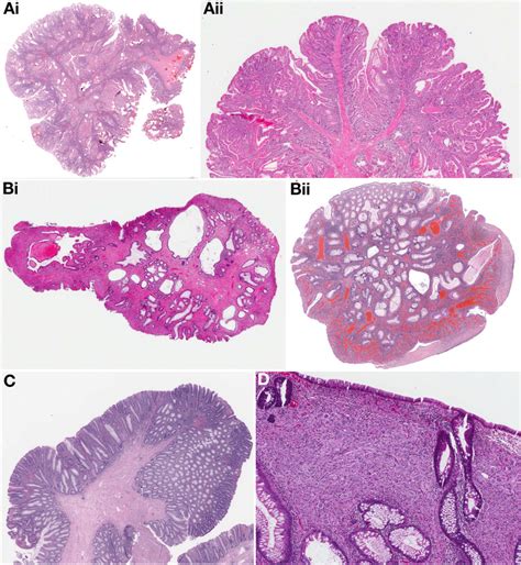 Diagnosis And Management Of Cancer Risk In The Gastrointestinal