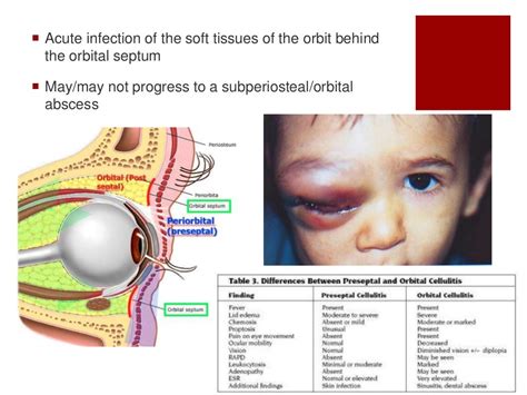 Orbital Cellulitis