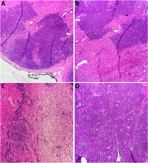 Bilateral Nephroblastomatosis With A Unilateral Wilms Tumor A Case