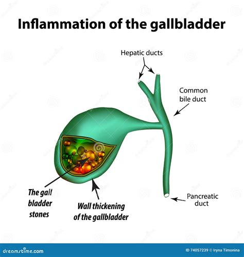 Gallstones Cholelithiasis Cholecystitis Inflammation Of The