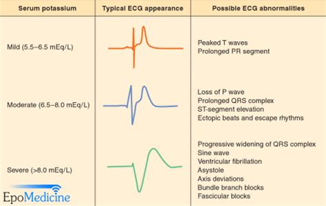 emDOCs.net – Emergency Medicine EducationECG Pointers: Hyperkalemia - The Great Imitator ...