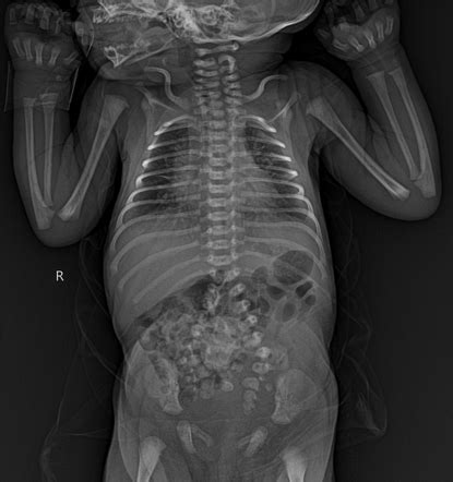 Caudal Duplication Syndrome Image Radiopaedia Org