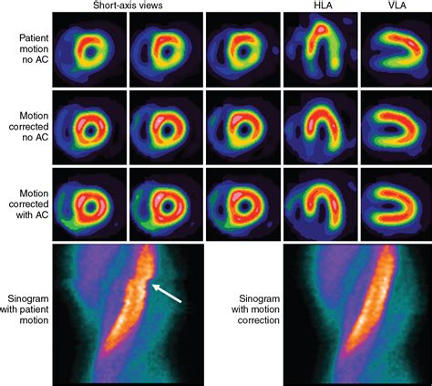 Single Photon Emission Computed Tomography Radiology Key