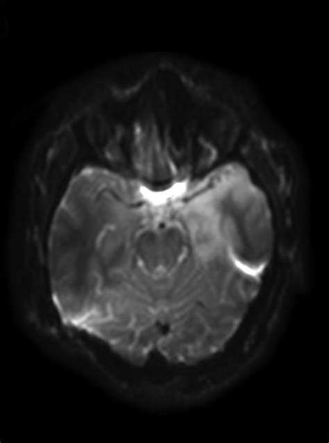 Improved Ct Detection Of Acute Herpes Simplex Virus Type Encephalitis