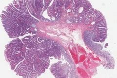 Tva Archives Atlas Of Pathology