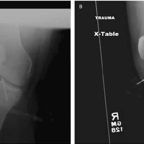 Anteroposterior A And Lateral B Radiographs Of Right Knee Revealing