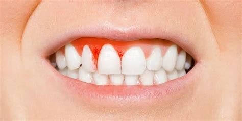 La gingivitis se puede prevenir Descubre cómo