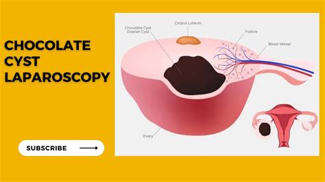 Chocolate Cyst In Ovary Endometriosis Cystectomy Youtube