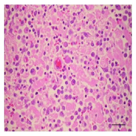 The Morphology Of Mct Cells Collected By Fna The Cells Were Round The