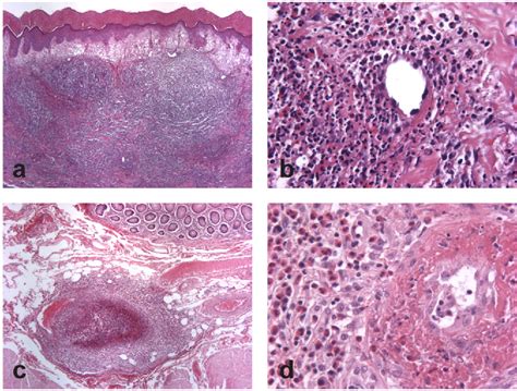 Figure From A Case Of Churg Strauss Syndrome Associated With