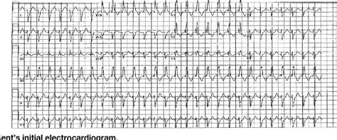 Figure 1 From Atrial Tachycardia Mimicking Atrioventricular Nodal