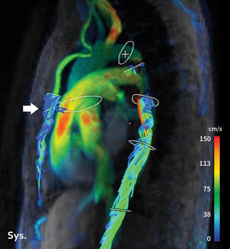 Four Dimensional Flow Mri Principles And Cardiovascular Applications