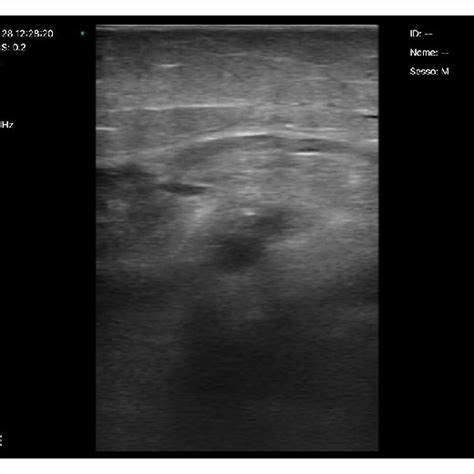 Ultrasound visualization of right superficial femoral artery and right... | Download Scientific ...