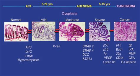 Colorectal Carcinogenesis Adenoma — Carcinoma Sequence Adapted From Download Scientific