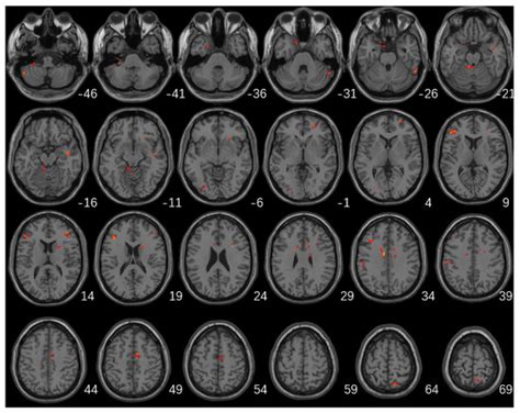 Brain Sciences Free Full Text Altered Fractional Amplitude Of Low