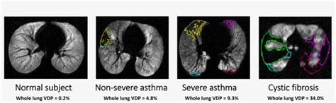 Examples Of Detected Ventilation Defect Boundaries Magnetic Resonance